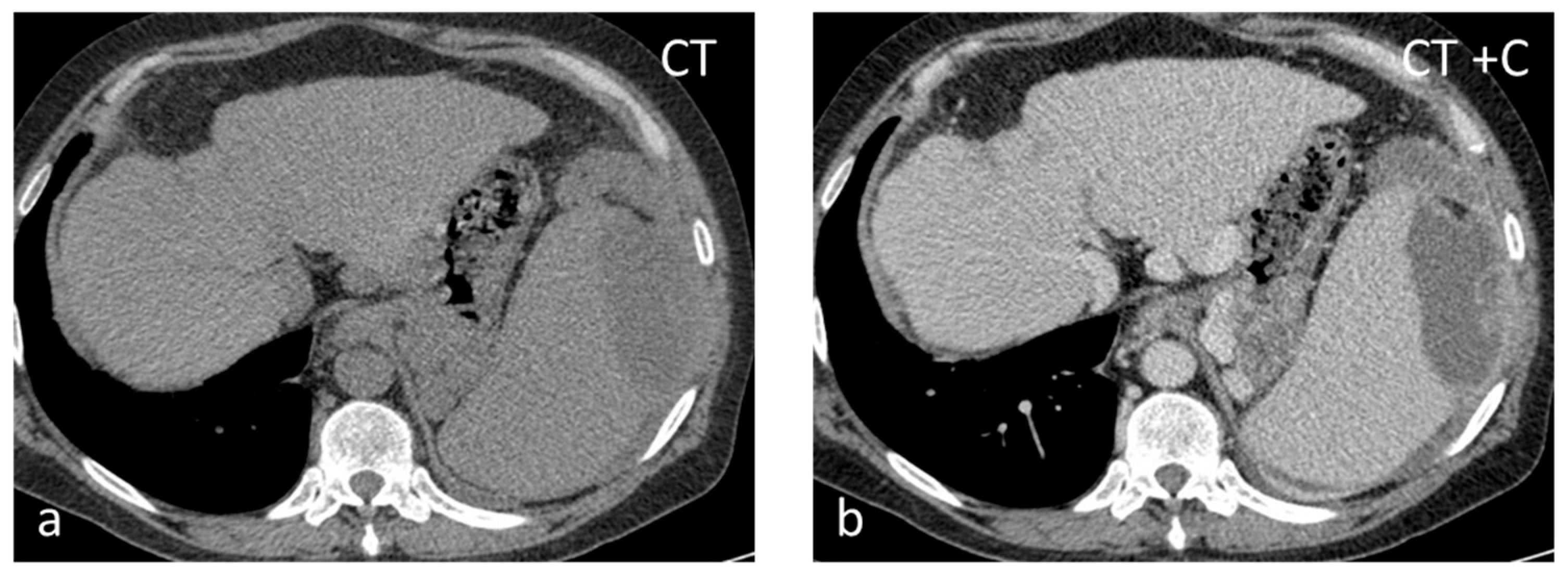 Diagnostics | Free Full-Text | The Spectrum of Solitary Benign Splenic ...