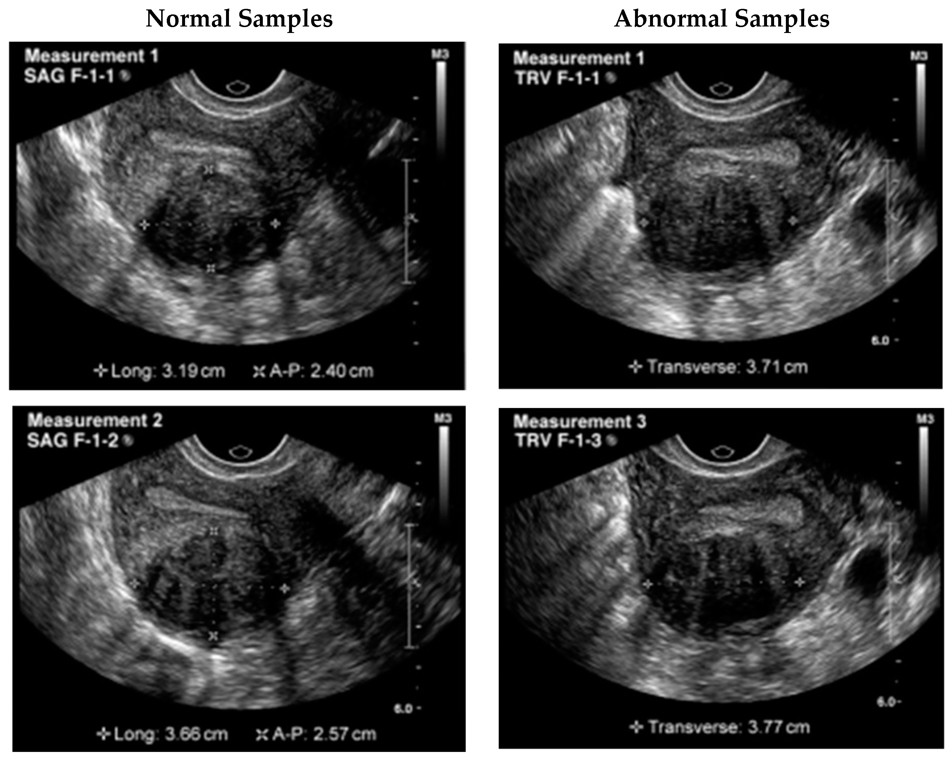 Uterine Fibroids Ultrasound