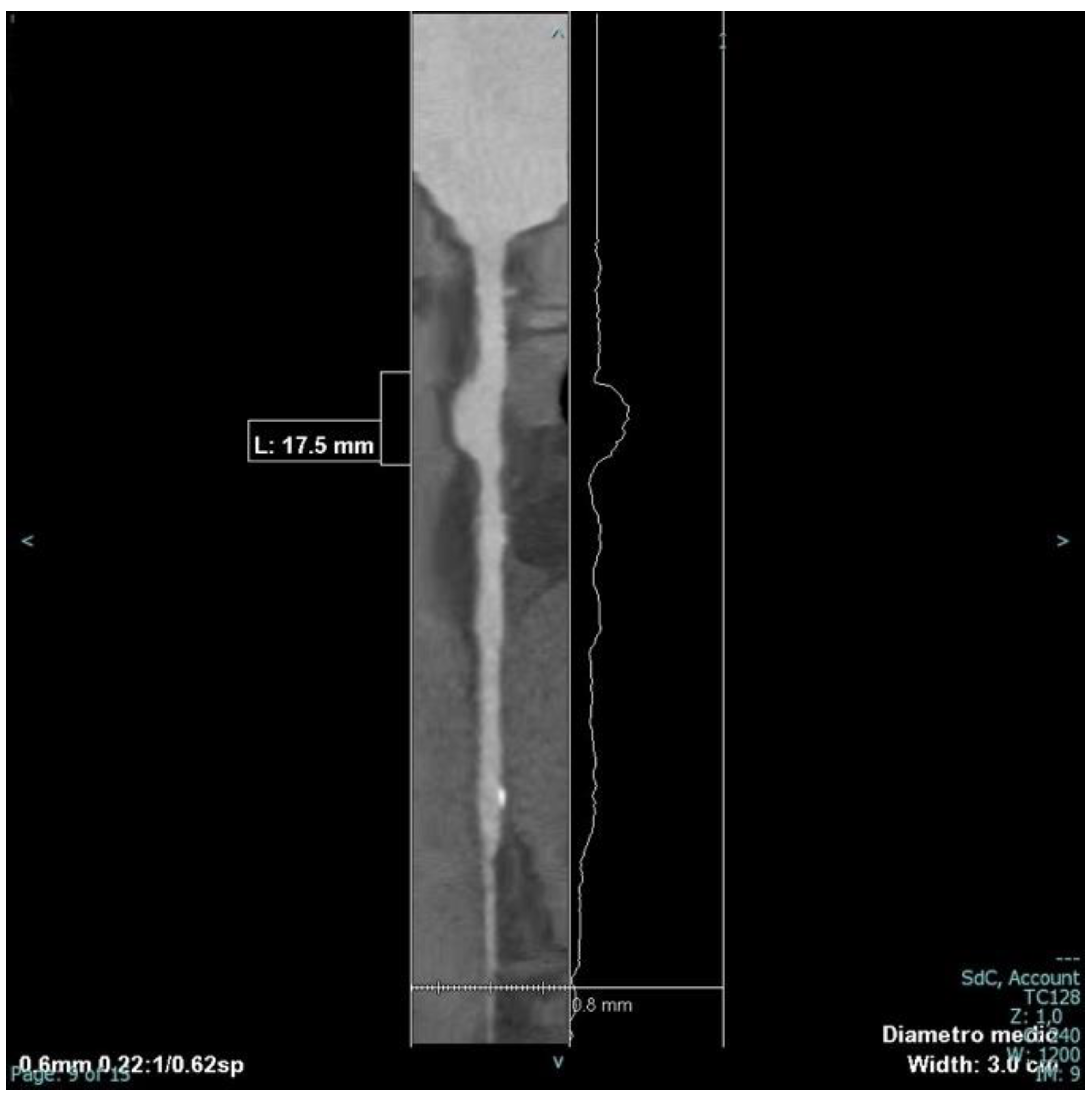 Coronary Artery Aneurysms: A Clinical Case Report and Literature Review ...