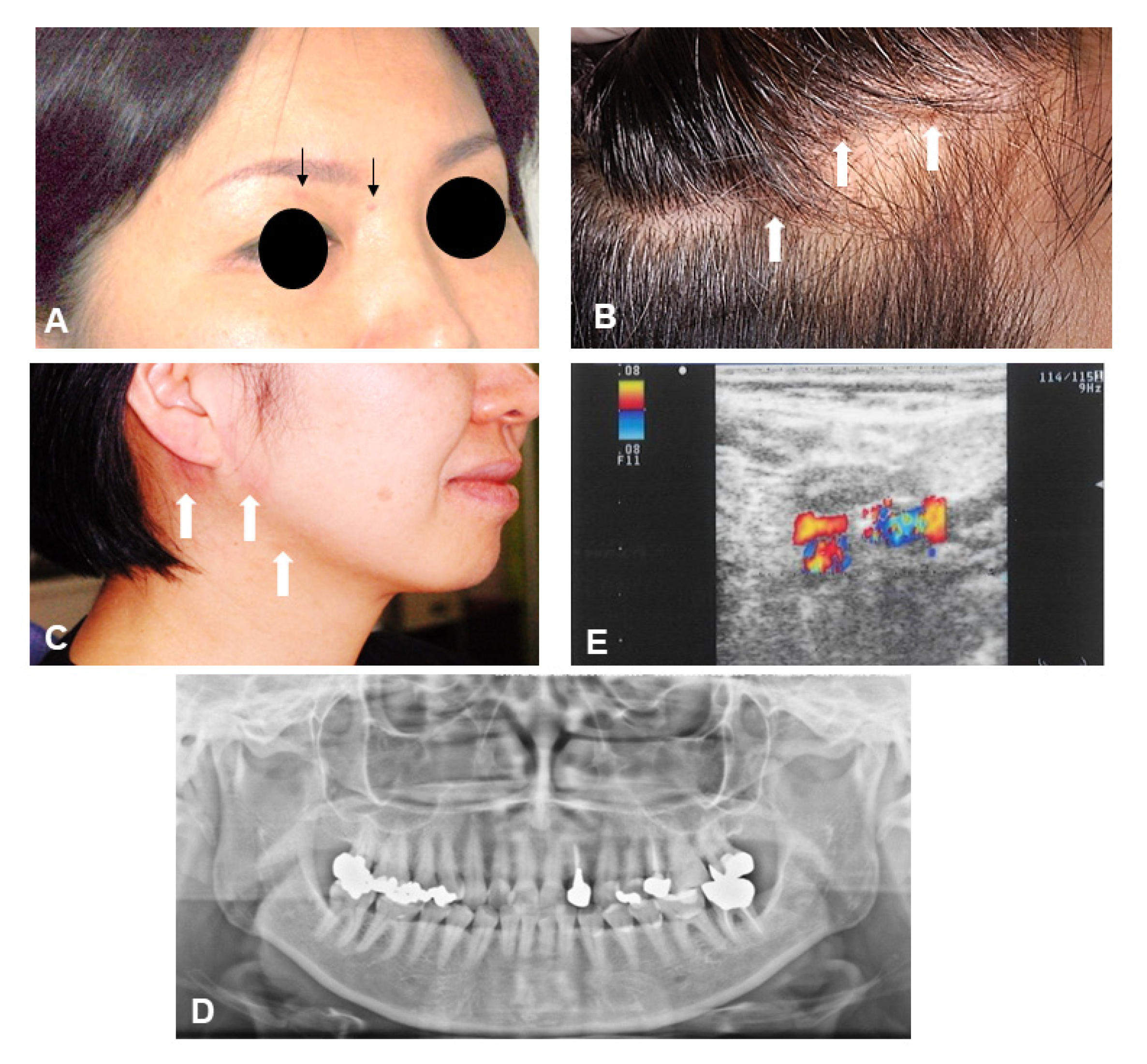 Lesser Occipital Nerve Blocks Coding