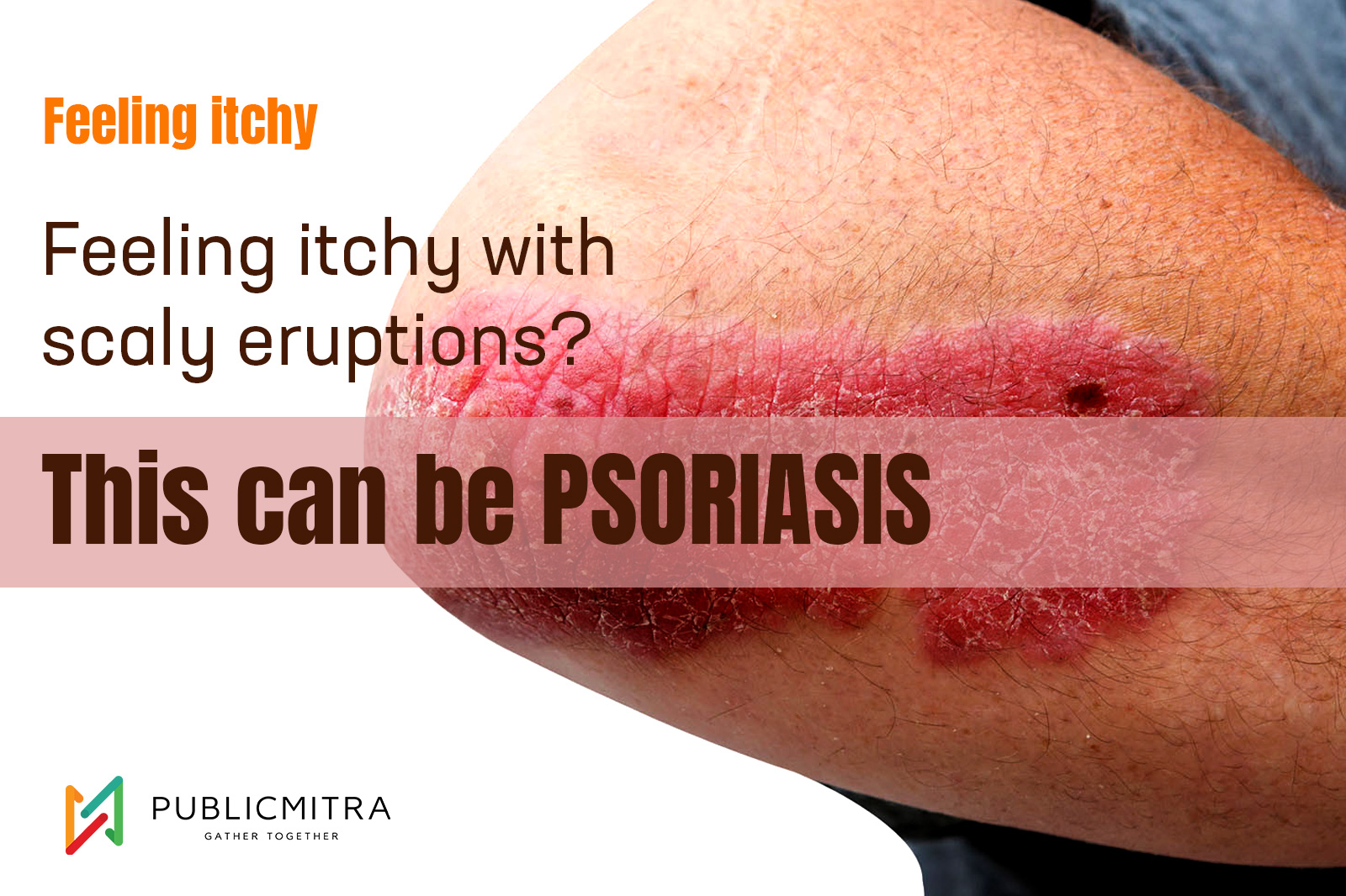 psoriasis