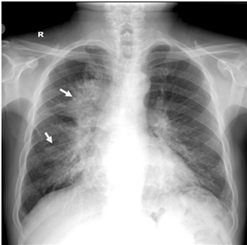 Pulmonary Involvement of Diffuse Large B-cell Lymphoma with Cavitary ...