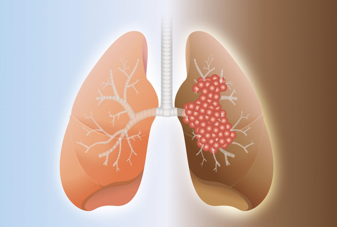 Pulmonary Fibrosis