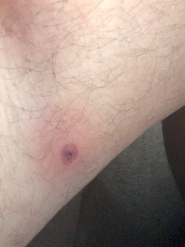 Tick Bites On People