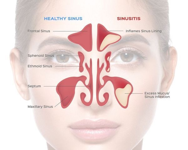 What Are Signs Of A Sinus Infection Quora