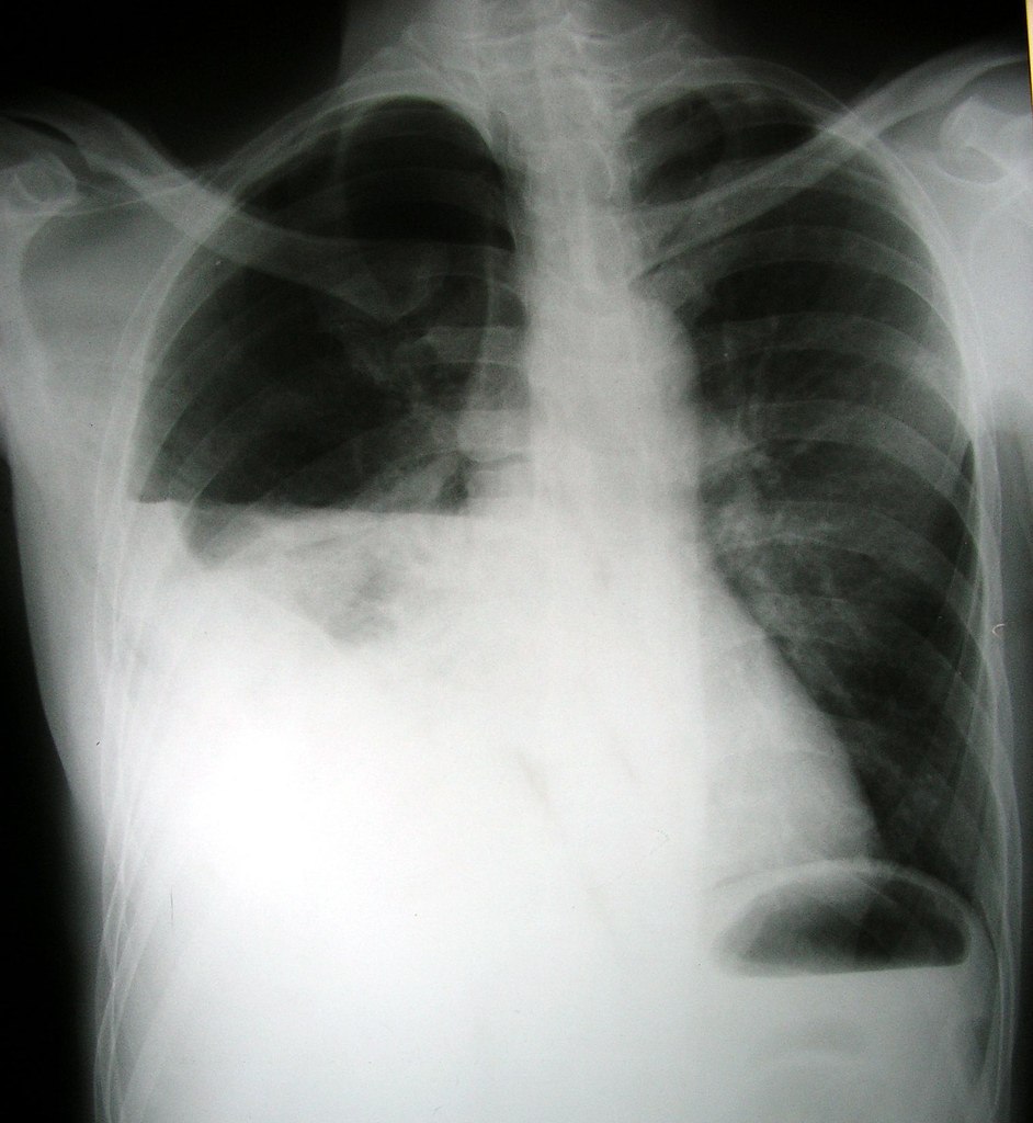 pneumothorax/hemothorax | Quizizz