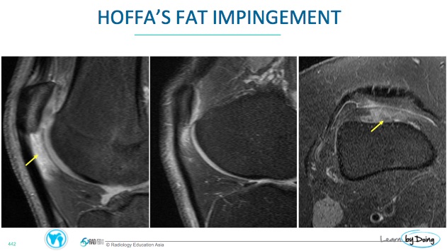 MRI Fat Pad Impingement Knee