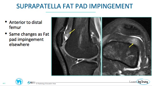 MRI Fat Pad Impingement Knee