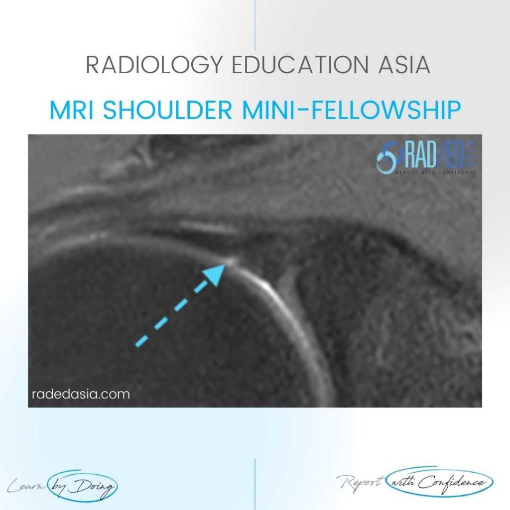 SHOULDER MRI BICEPS LABRUM JUNCTION: Q&A FROM THE COURSE - Radedasia