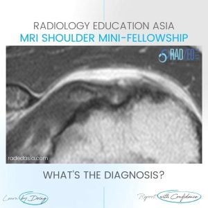 biceps dislocation radiology mri shoulder