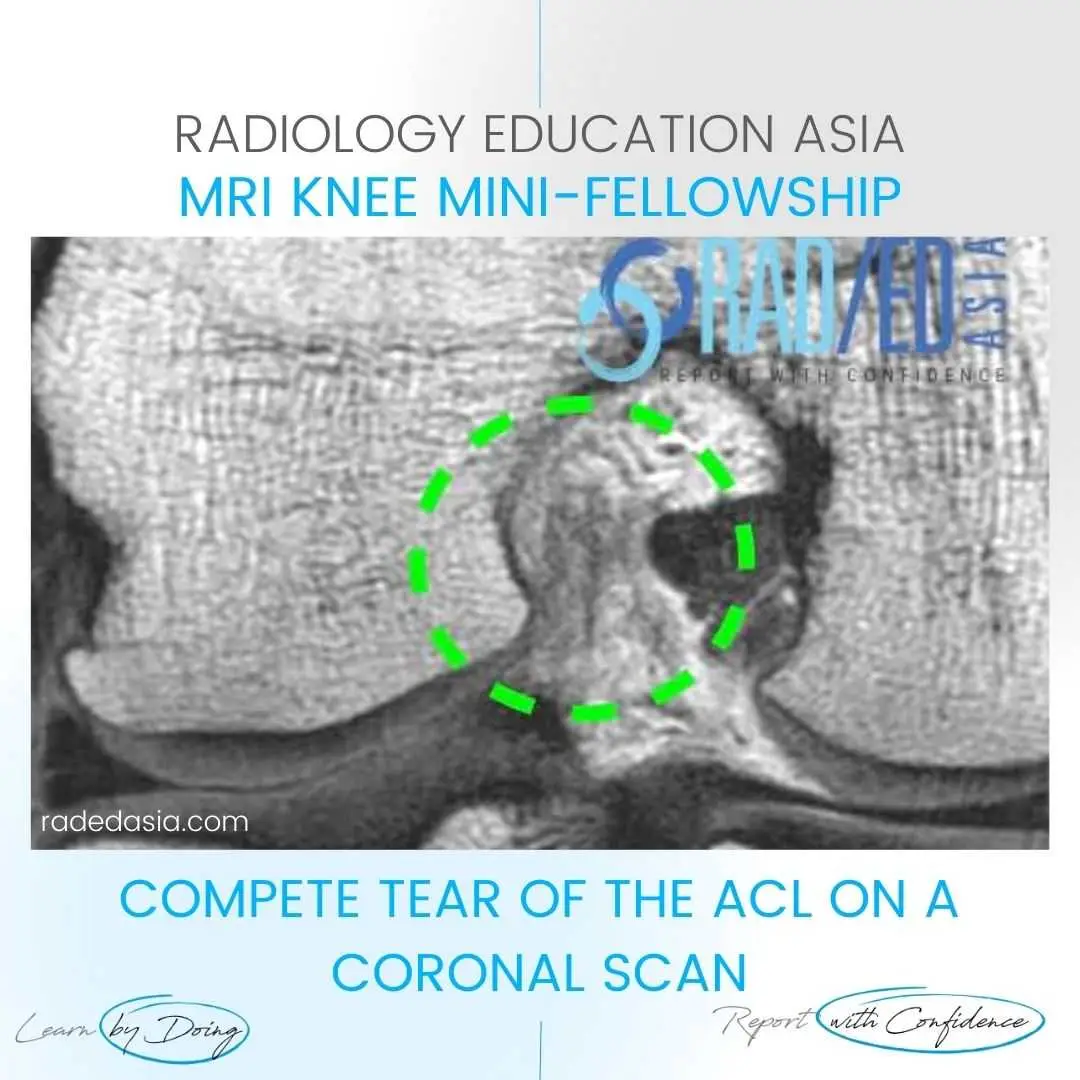 acl-tear-mri-images-findings-knee-full-thickness-coronal-radiology-radedasia.jpg