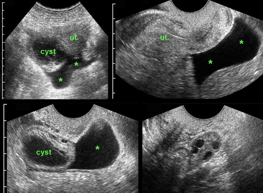 The Radiology Assistant : Acute Abdomen in Gynaecology - Ultrasound