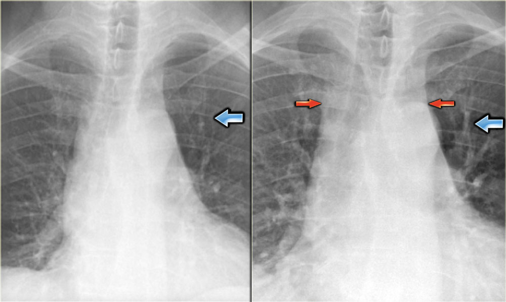 The Radiology Assistant : Chest X-Ray - Heart Failure