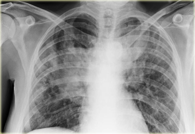 Interstitial Pneumonia X Ray