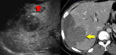 Adenoma with hemorrhage