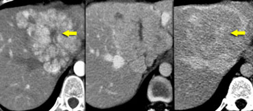 Two FNHs with late enhancing central scar