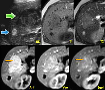 Hemangioma and FNH on ultrasound and dynamic MR.