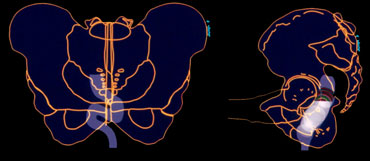 During straining a S-shaped rectum may simulate intussusception in lateral projection.