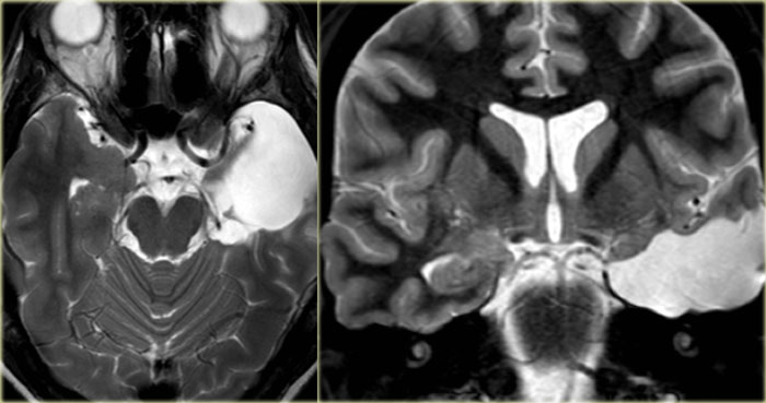 Left mesial temporal sclerosis treated with amygdalo-hippocampectomy