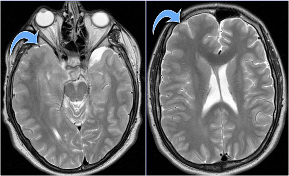 Hemimegalencephaly.  (Courtesy of Alessandra D'Amico)