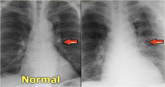 Congenital Heart Disease Xray