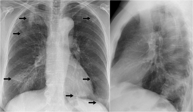 Chest X Ray Consolidation Vs Infiltrate