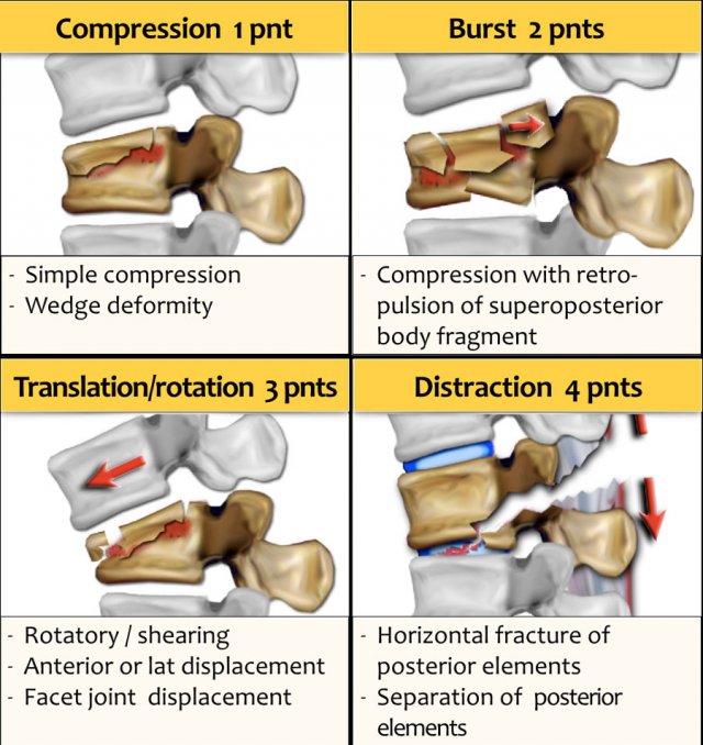 Compression Fractures