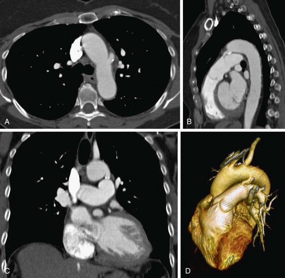 Patent Ductus Arteriosus Ct