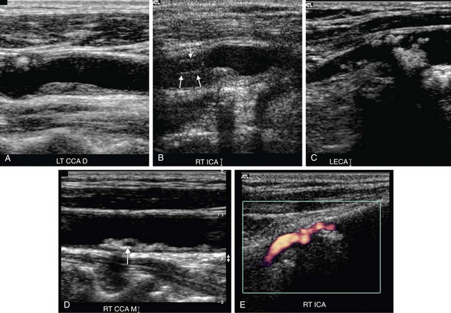 Carotid Arteries Ultrasound