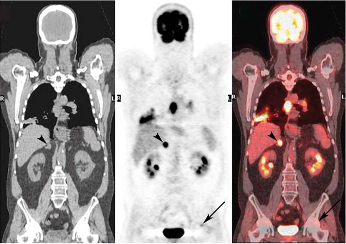 Pet Scan Images Lung Cancer