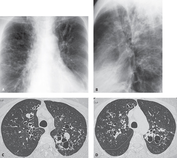 27 Allergic Bronchopulmonary Disease | Radiology Key