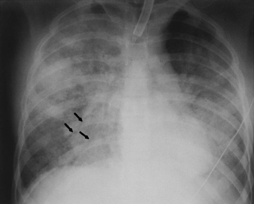 Miscellaneous Chest Diseases | Radiology Key