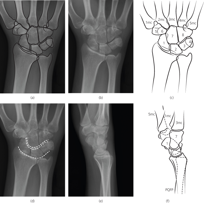 Wrist Anatomy Xray