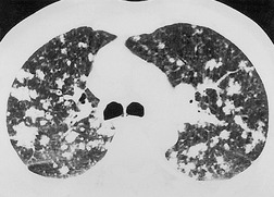 3. Basic patterns in lung disease | Radiology Key