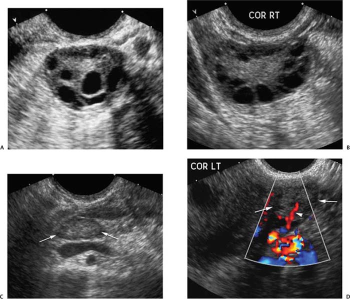 Family History of Ovarian Carcinoma | Radiology Key