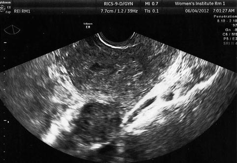 Uterine Fibroids Ultrasound