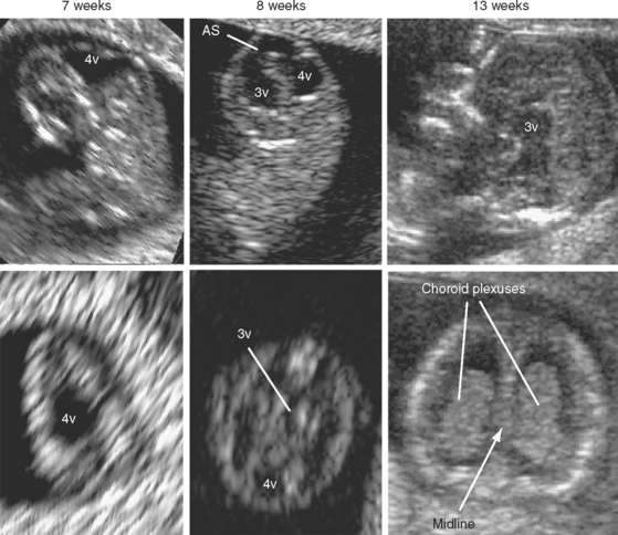 ULTRASOUND EVALUATION OF THE FETAL NEURAL AXIS | Radiology Key