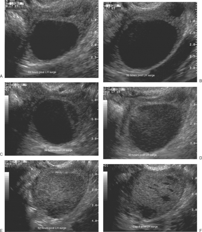 ULTRASONOGRAPHIC IMAGING IN INFERTILITY | Radiology Key