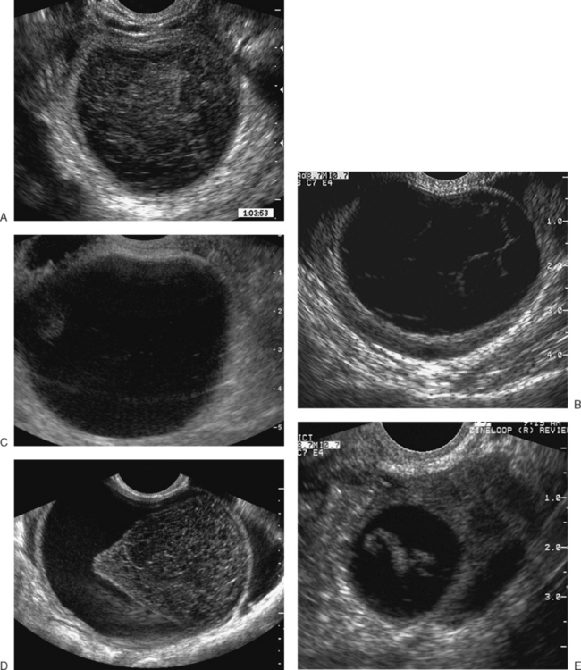 ULTRASONOGRAPHIC IMAGING IN INFERTILITY | Radiology Key