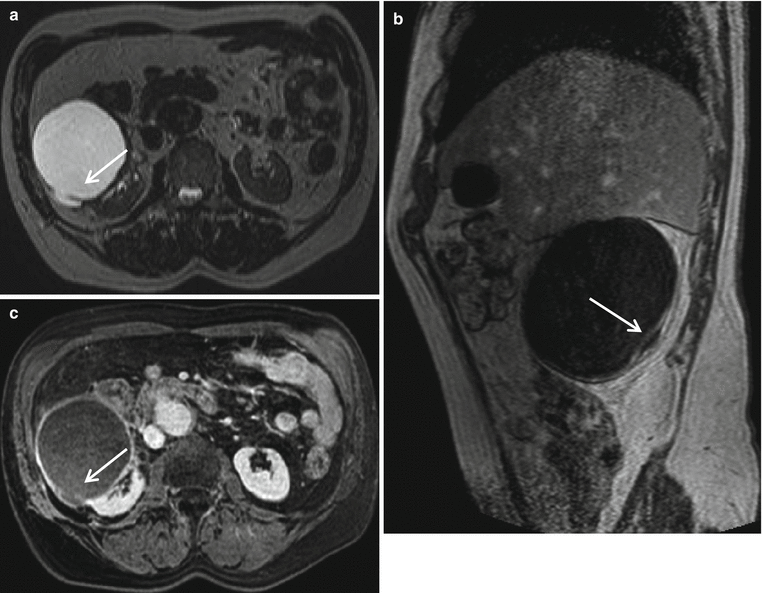 Resonance Imaging of the Kidney | Radiology Key