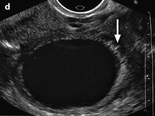 Pelvic Inflammatory Disease Ultrasound