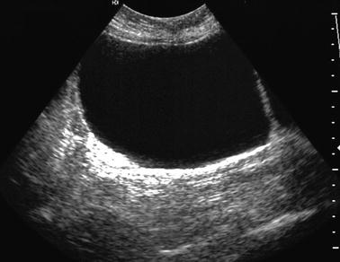 Functional Lesions of the Ovary | Radiology Key