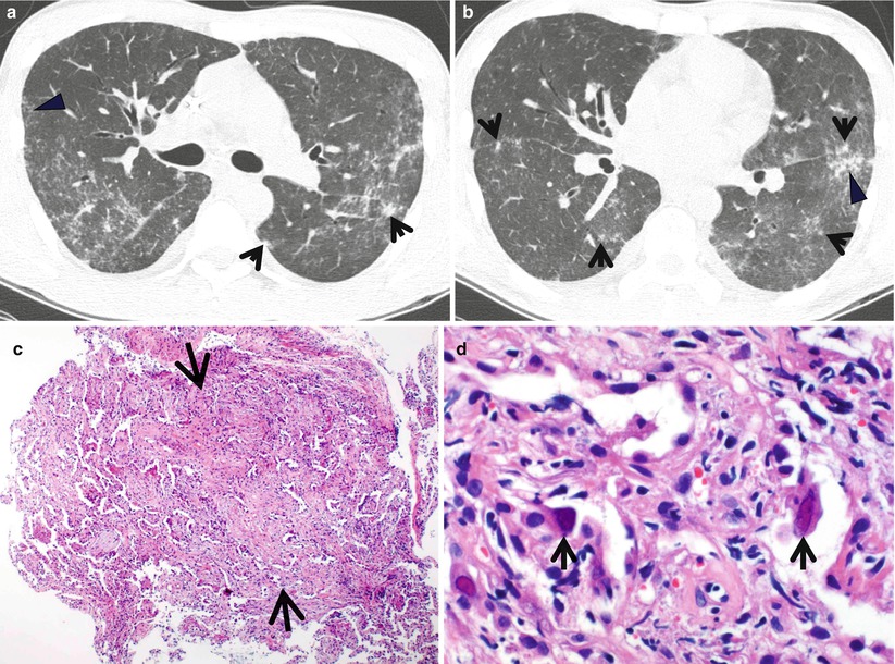 Ground-Glass Opacity without Reticulation | Radiology Key