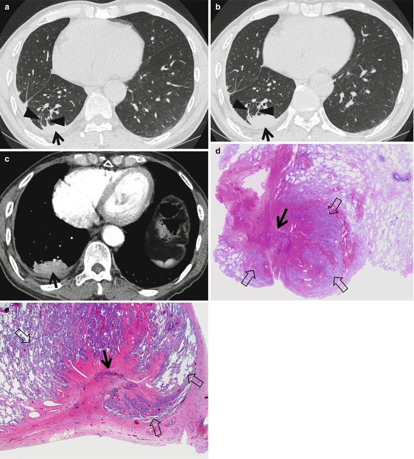 Comet Tail Sign | Radiology Key