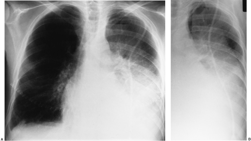 Disease of the Pleura | Radiology Key