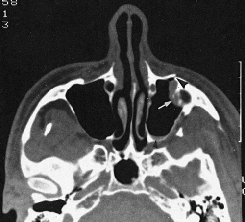 Facial Trauma | Radiology Key