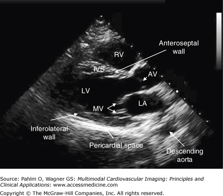 Echocardiography | Radiology Key