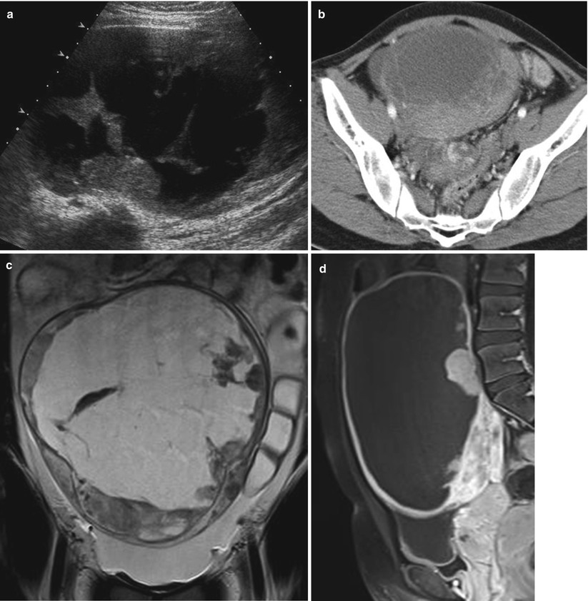 Pediatric Uterus, Ovary, and Testis Diseases | Radiology Key