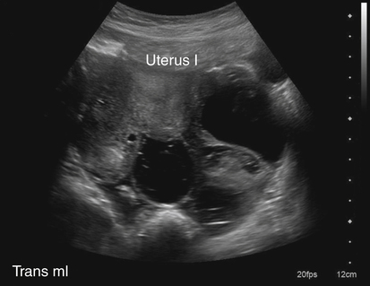 Pelvic Inflammatory Disease Ultrasound