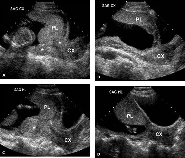 Placenta | Radiology Key